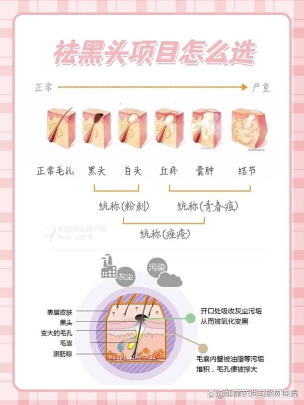 现金万博manbext网站登录app平台咱们邀请皮肤科群众为您证实黑头的成因与科学措置决议-万博manbext网站登录 万博manbext体育官网注册账号